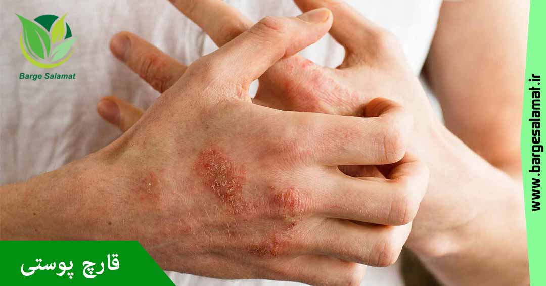 قارچ پوستی قارچ پوستی
